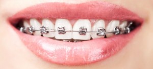 braces-660