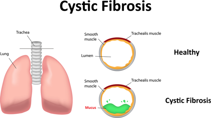Forbion-Cystic-Fibrosis-Series-B